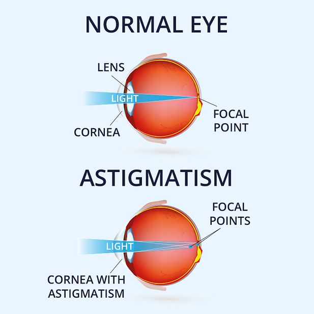 Labelled diagram of an eyeball with and without astigmatism