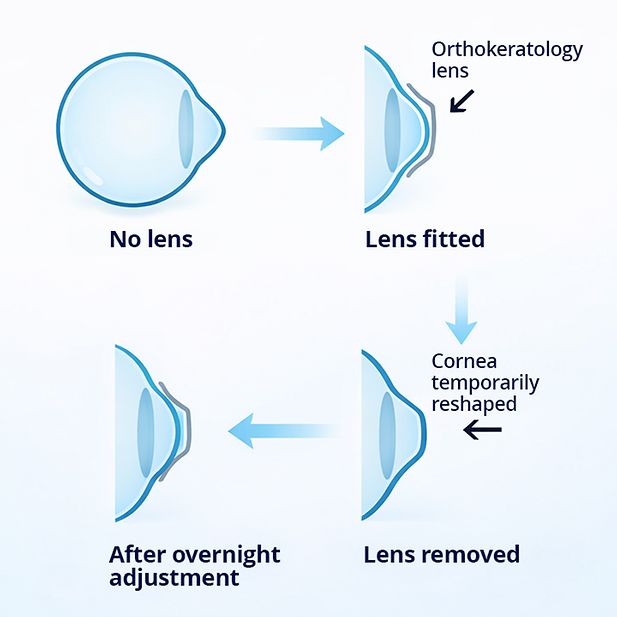 diagram of the shape of an eyeball before, during, and after an Ortho-k lens is used