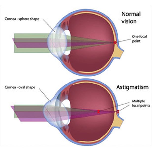 Contact_lenses_vision_problems_row_8