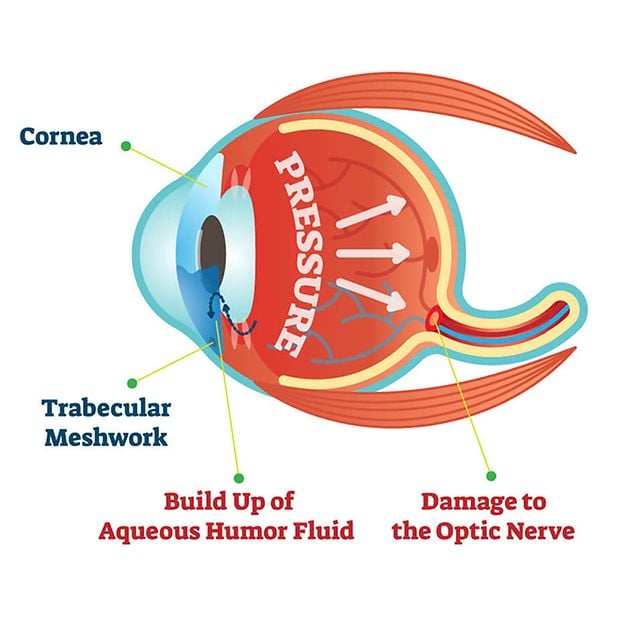 What_is_glaucoma_row_3